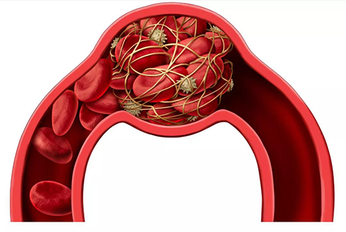 脑中风是一种以脑部缺血及出血性损伤症状为主要临床体现的疾病