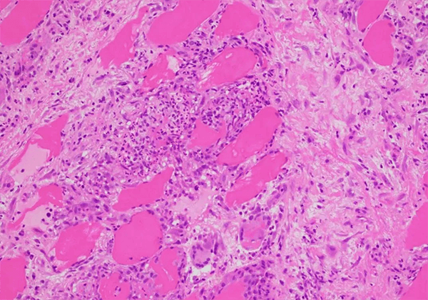 【CA88助力】治疗结节病的KBMAB-16获FDA批准临床